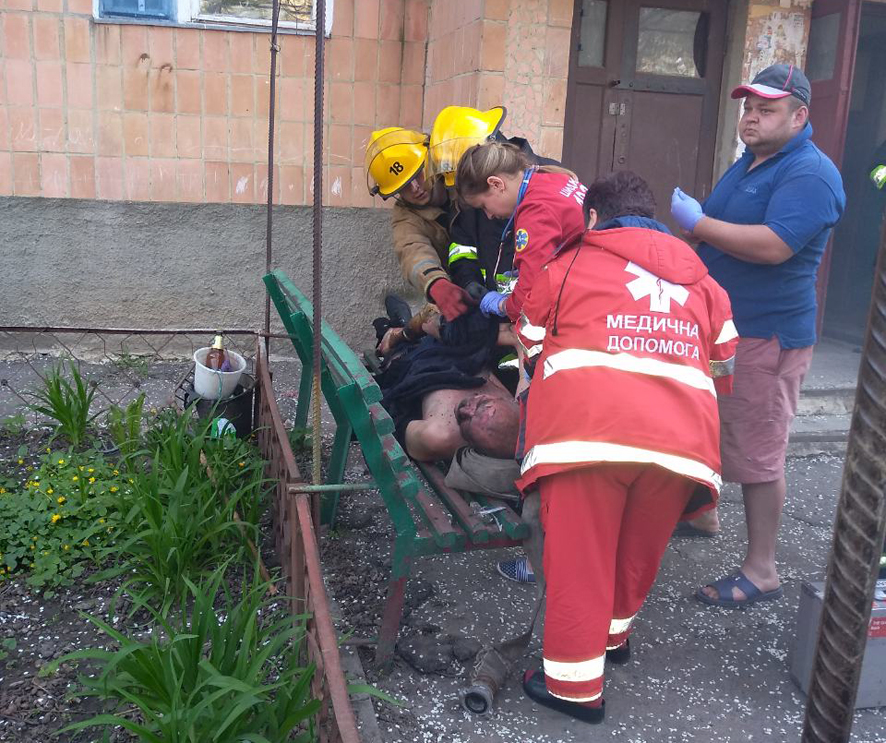 В Лубнах спасли мужчину, который получил 60% ожогов тела (фото)