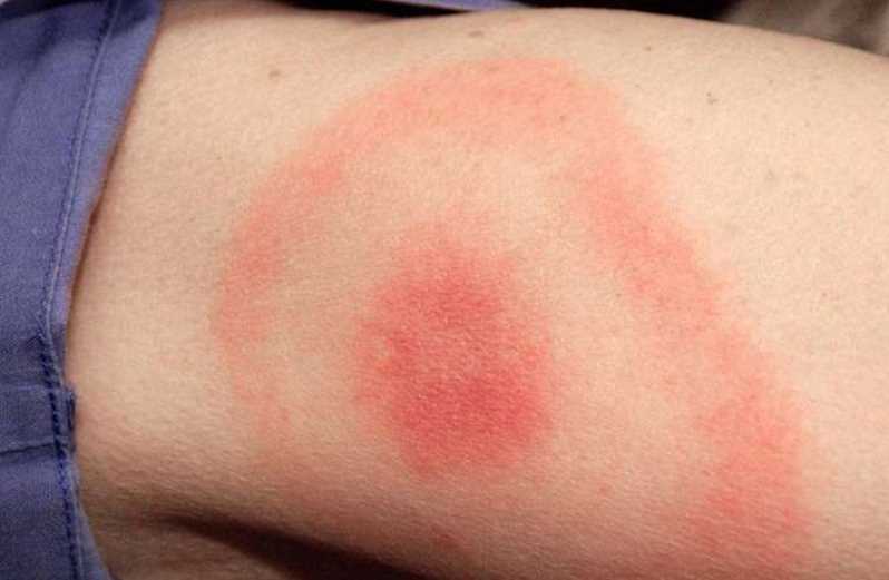 На Полтавщині за тиждень зафіксували 23 випадки хвороби Лайма